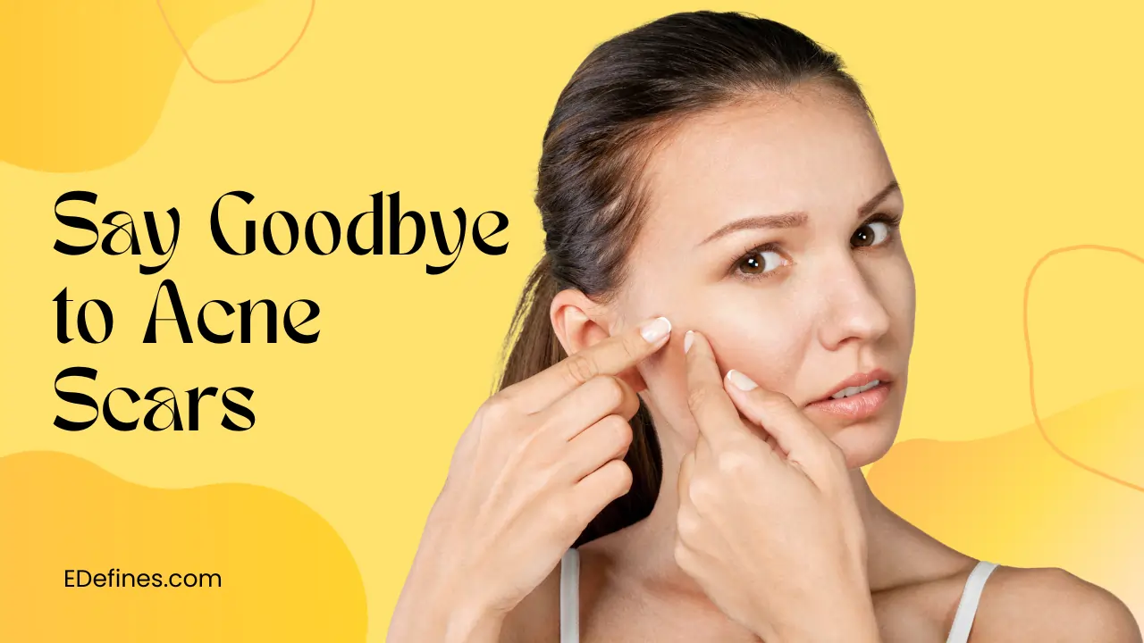 How To Say Goodbye To Acne Scars Naturally